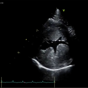Diagnostic imaging of a cat's heart with a dark patch in it