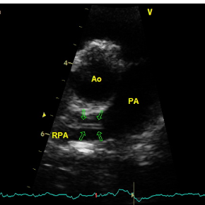 An echocardiogram image showing a heartworm in the pulmonary artery of a canine patient