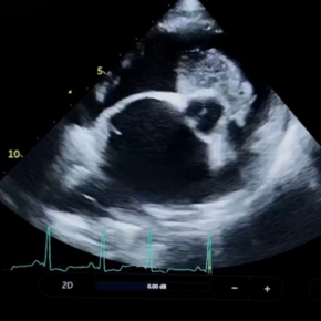 Echocardiogram