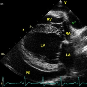 A black and white heart scan with markers on
